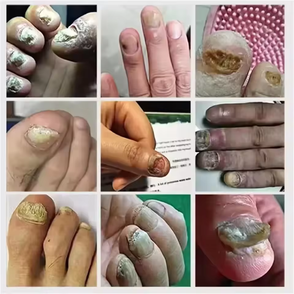 7 jours traitements fongiques des ongles sérum liquide Anti-Infection onychomycose Paronychia soin d