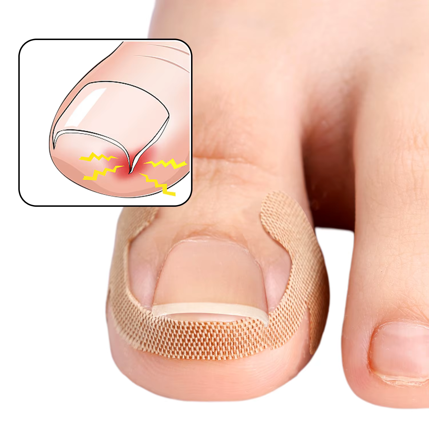 Bandes correctrices pour ongles incarnés, 100 pièces, adhérence durable, autocollants imperméables, 