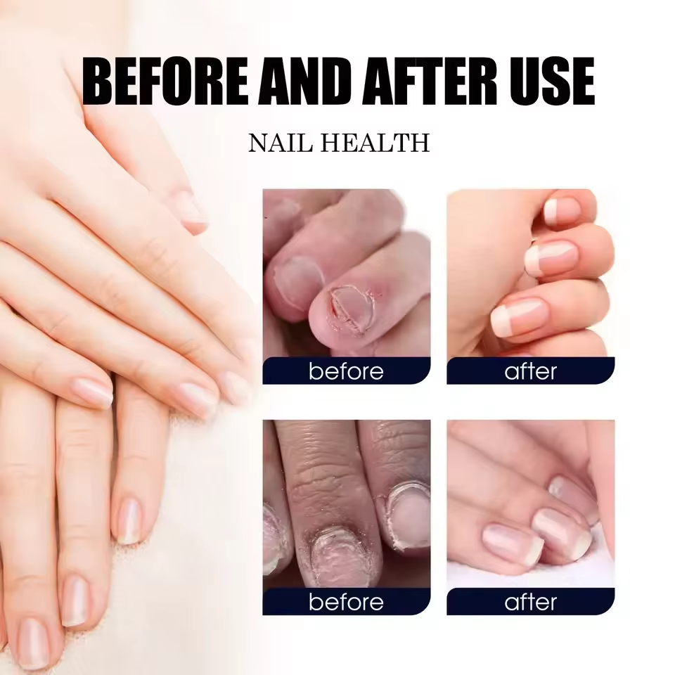 7 jours traitements fongiques des ongles sérum liquide Anti-Infection onychomycose Paronychia soin d