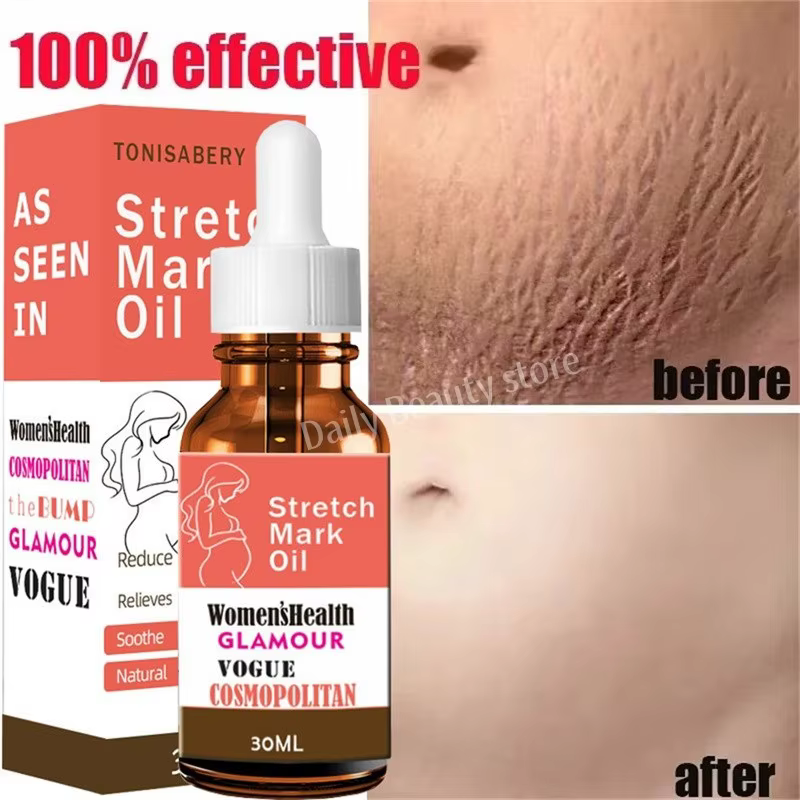 Dissolvant de vergetures, huile essentielle, grossesse, maternité, corps, nouveau vieux sérum d'élim