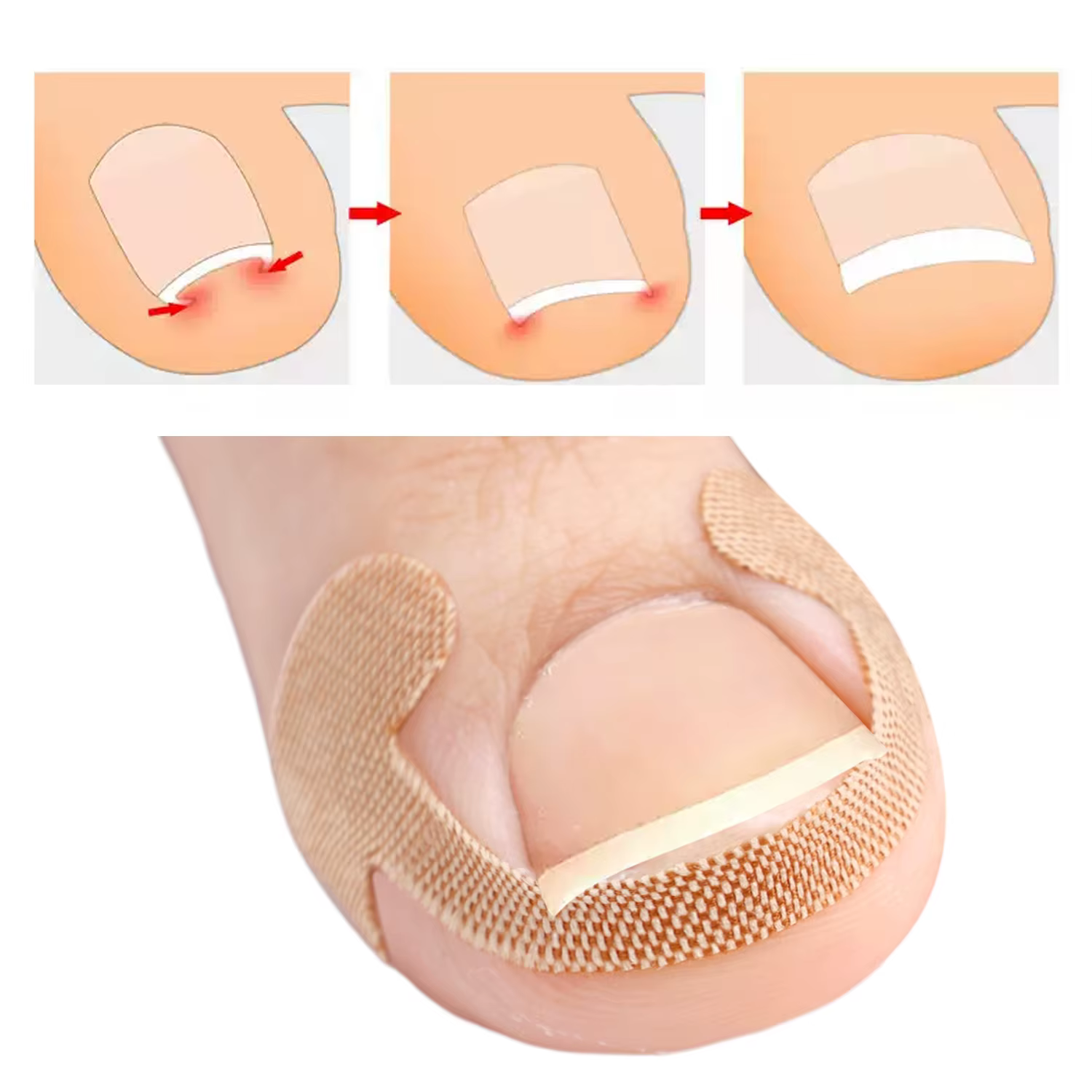 Bandes correctrices pour ongles incarnés, 100 pièces, adhérence durable, autocollants imperméables, 