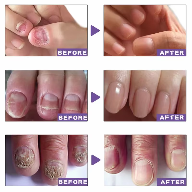 Sérum de traitement des champignons des ongles, liquide de réparation des pieds, Gel d'élimination d