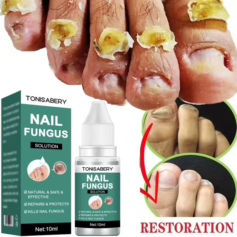 Sérum de traitement des champignons des ongles, liquide de réparation des pieds, Gel d'élimination d
