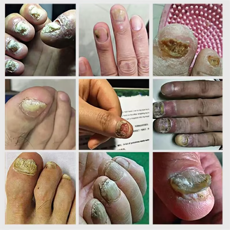 Sérum de traitement fongique des ongles, élimination des champignons des pieds, Gel de réparation, A