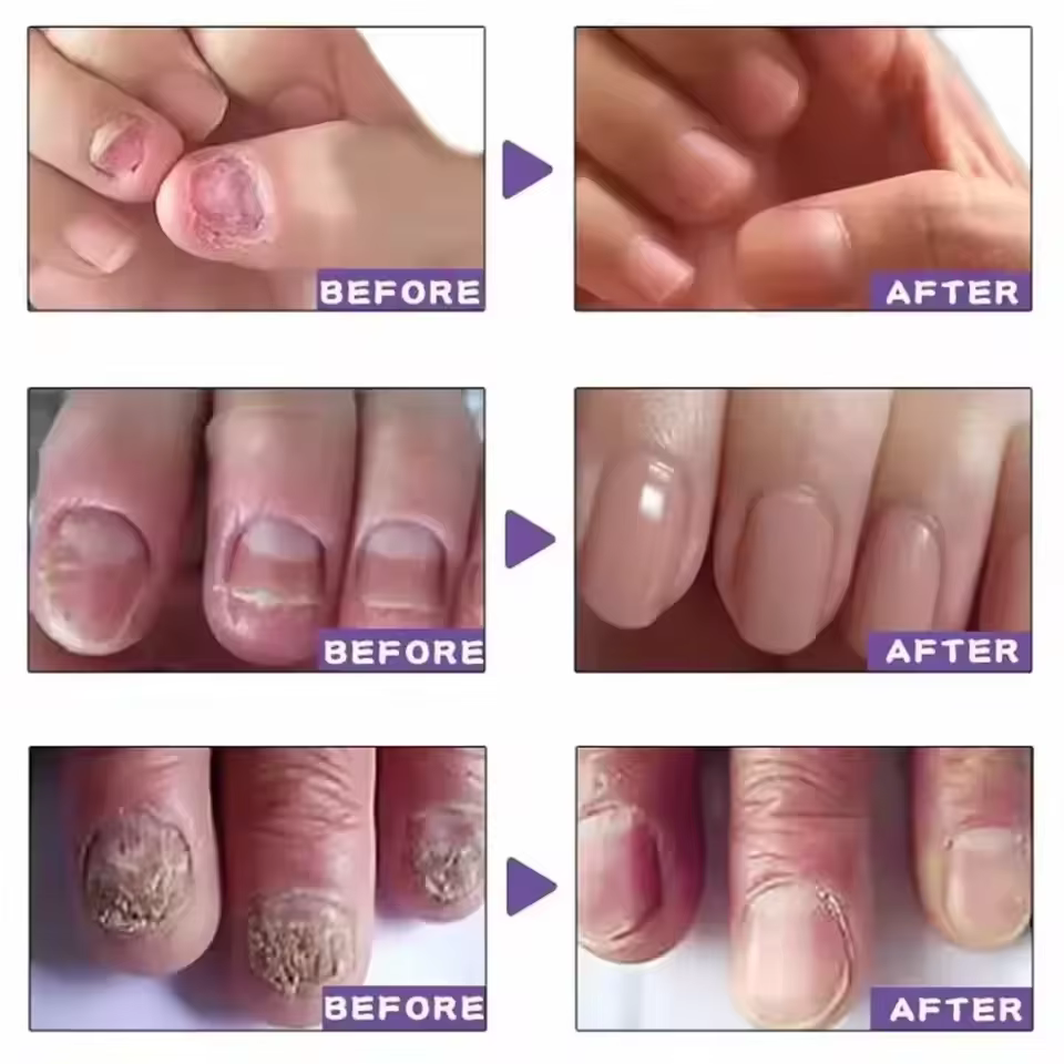 7 jours traitements fongiques des ongles sérum liquide Anti-Infection onychomycose Paronychia soin d