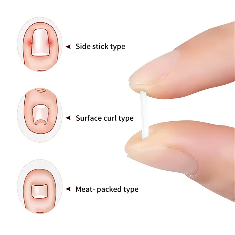 Outil de Correction des ongles incarnés