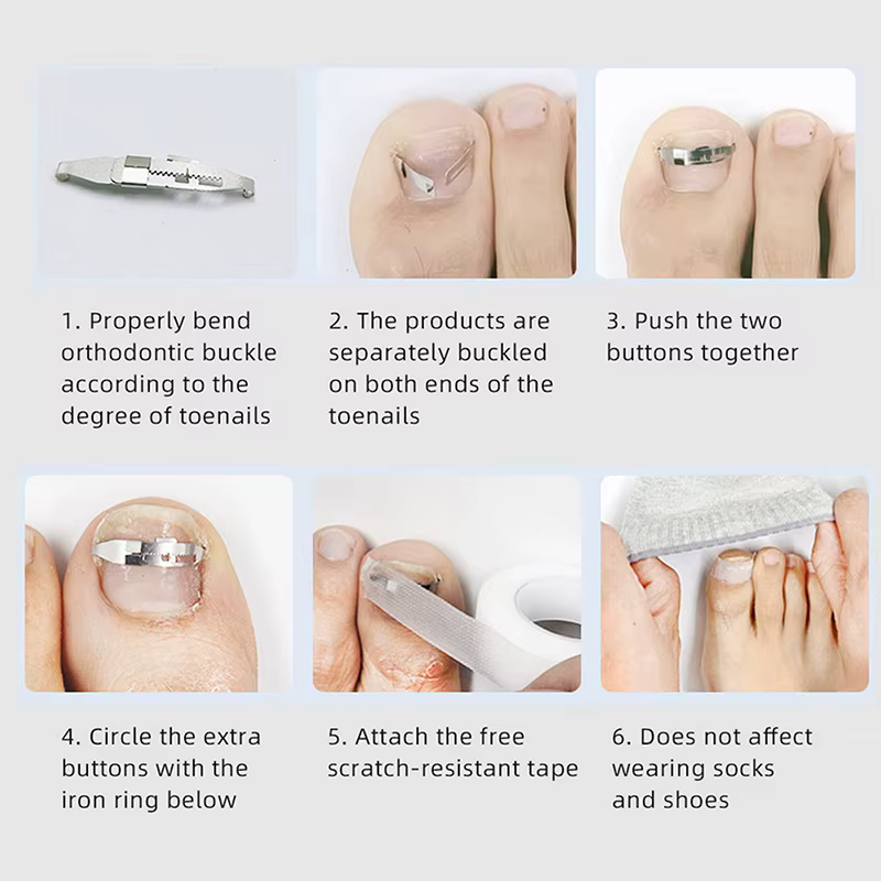 Correcteur d'ongles incarnés