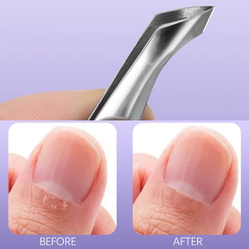 Nouvel outil de manucure Hangnail Squeeze And Snip pour retirer les ongles incarnés