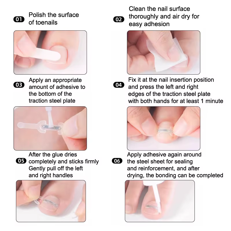 Soins des ongles, Correction des ongles incarnés