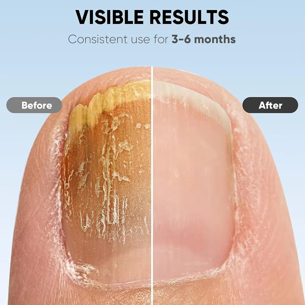 Appareil laser LED pour le traitement des mycoses des ongles