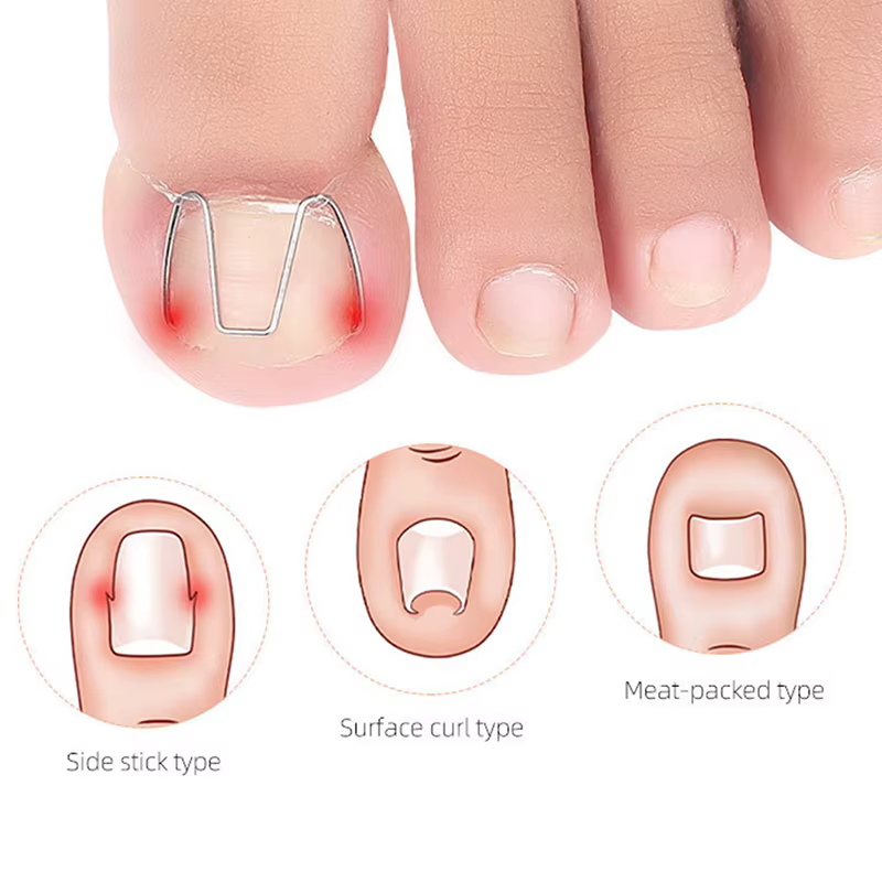 Outil de Correction des ongles incarnés, orthèse des ongles, Clip Paronychia