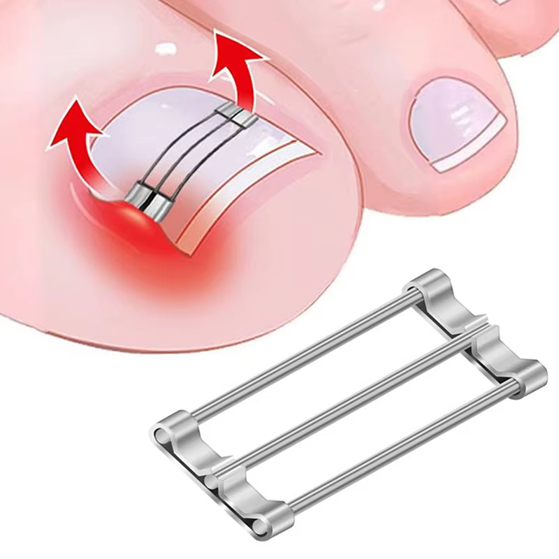 Correcteur d'ongles incarnés