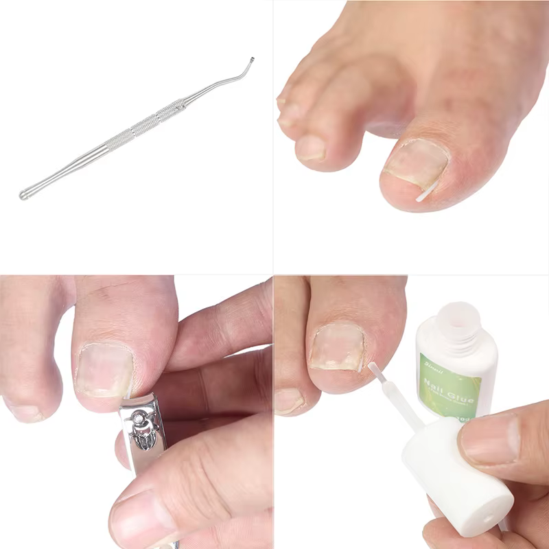 Outil de Correction des ongles incarnés