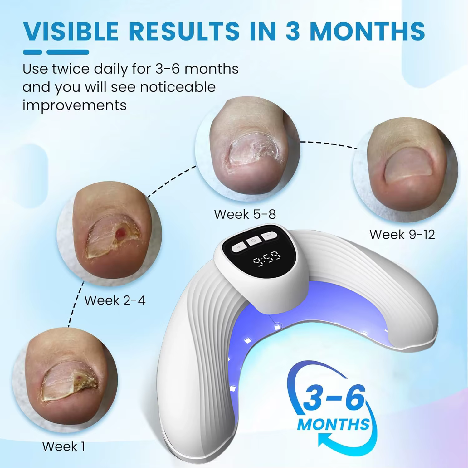 Dispositif laser de traitement des champignons des ongles – Élimine