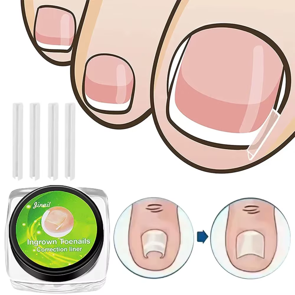 Outil de Correction des ongles incarnés