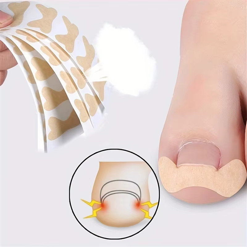 Patch Ortho pour Ongles Incarnés