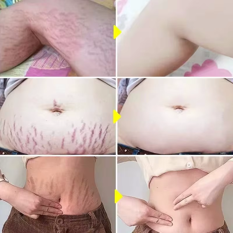 Dissolvant de vergetures, huile essentielle, grossesse, maternité, corps, nouveau vieux sérum d'élimination des vergetures, augmente l'élasticité de la peau