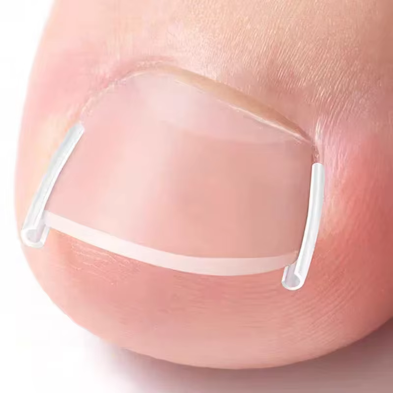 Outil de Correction des ongles incarnés