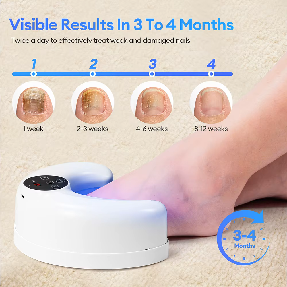 Appareil laser pour le traitement des ongles