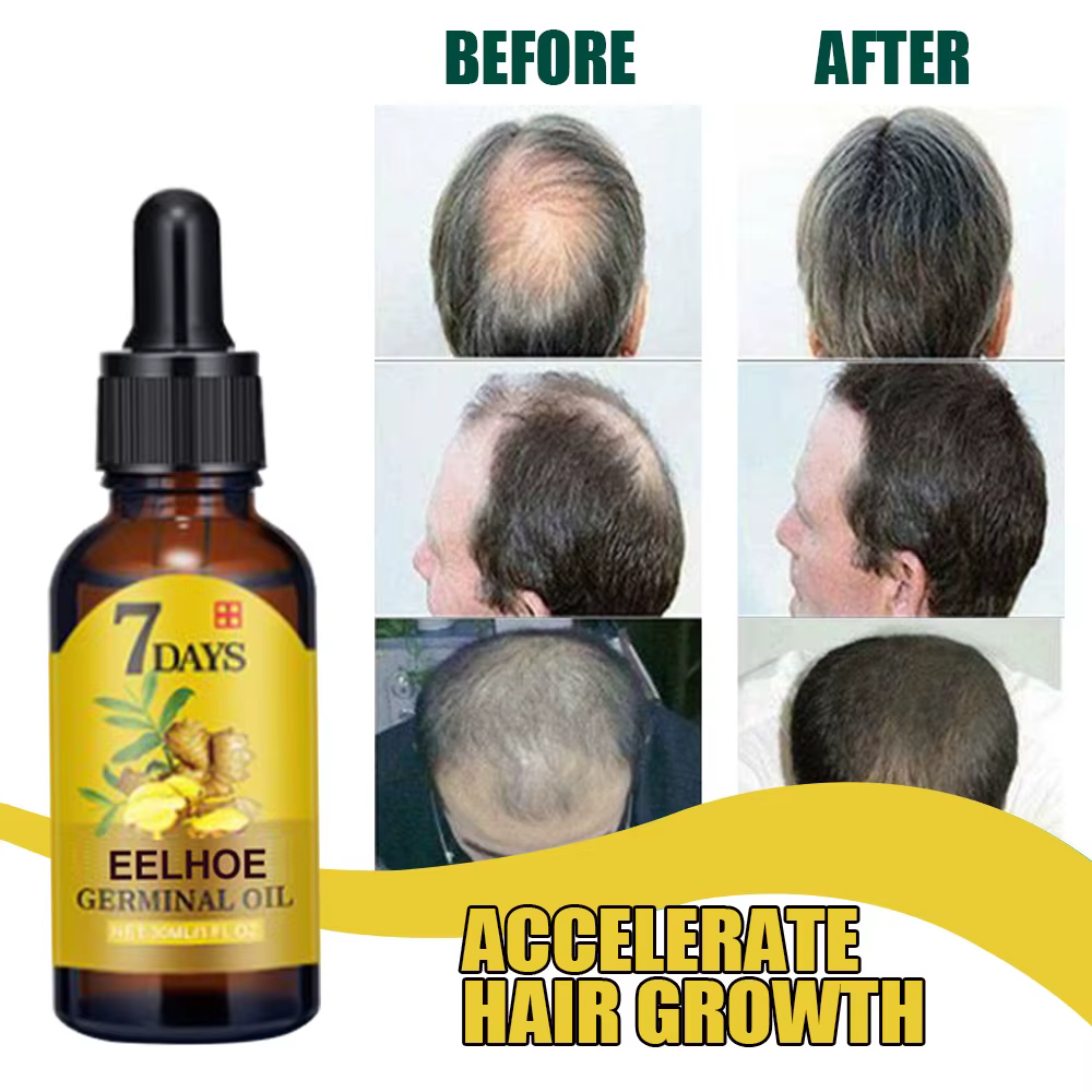 EELHOE – huile de gingembre pour la croissance des cheveux, pour le Massage du cuir chevelu, traitement des follicules pileux, soins capillaires, Essence germinale pour la repousse et la perte