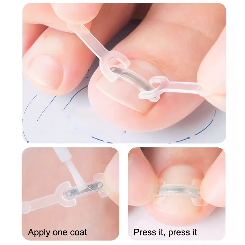 Soins des ongles, Correction des ongles incarnés