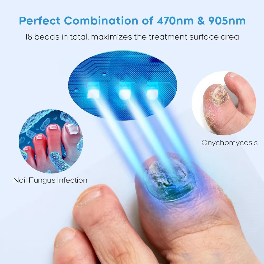 Dispositif de traitement au Laser pour champignons des ongles