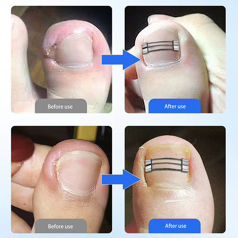 Correcteur d'ongles incarnés