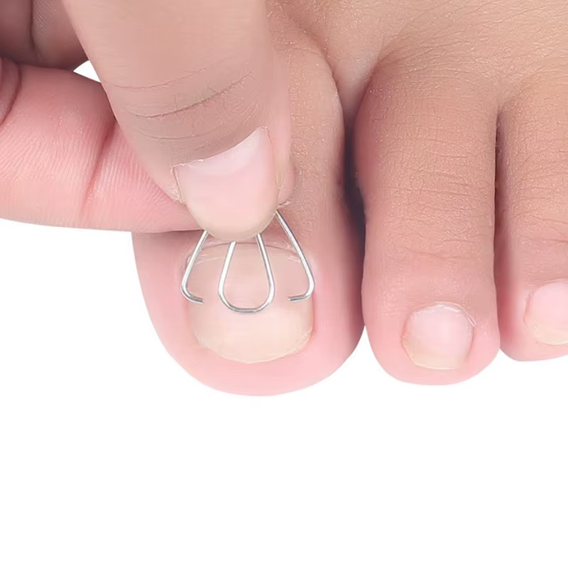 Outil de Correction des ongles incarnés, orthèse des ongles, Clip Paronychia
