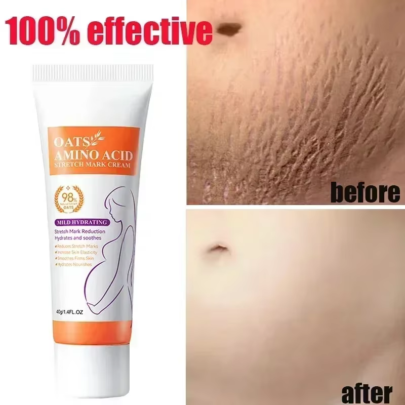 Crème d'élimination permanente des vergetures de maternité, éclaircissante, Anti-rides, réparation lisse, raffermissant, restauration de l'élasticité de la peau, soins pour la peau du corps