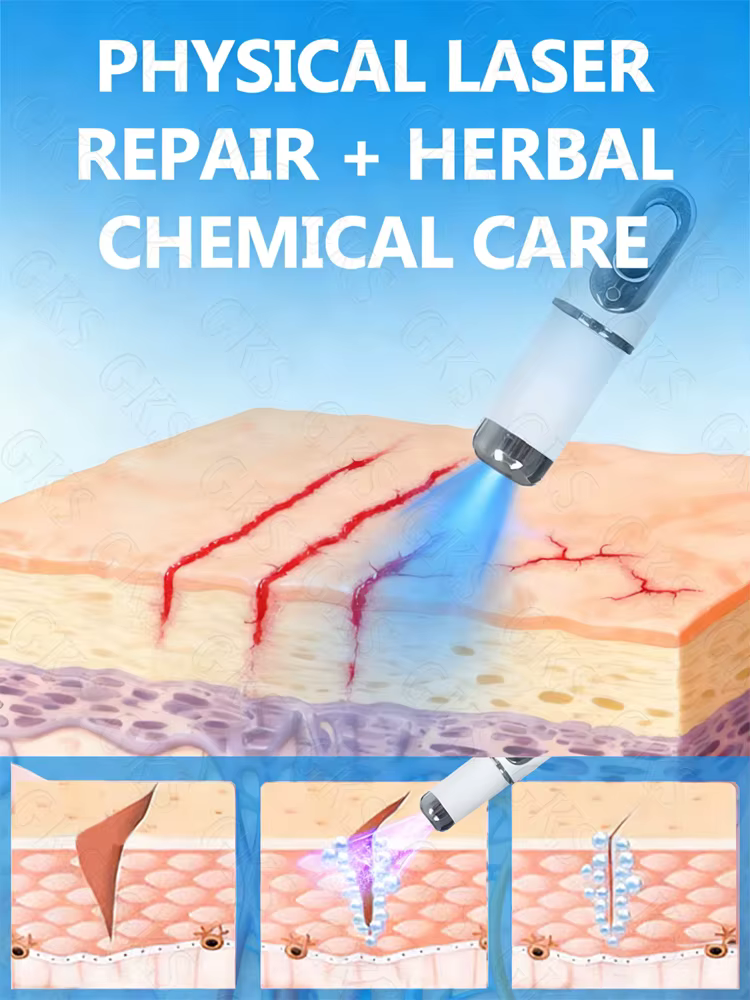 Traitement laser avancé pour les vergetures - adapté à tous les types de peau