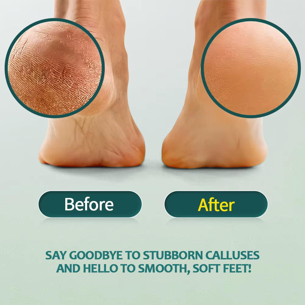 Nailpop – dissolvant de callosités professionnel pour pieds