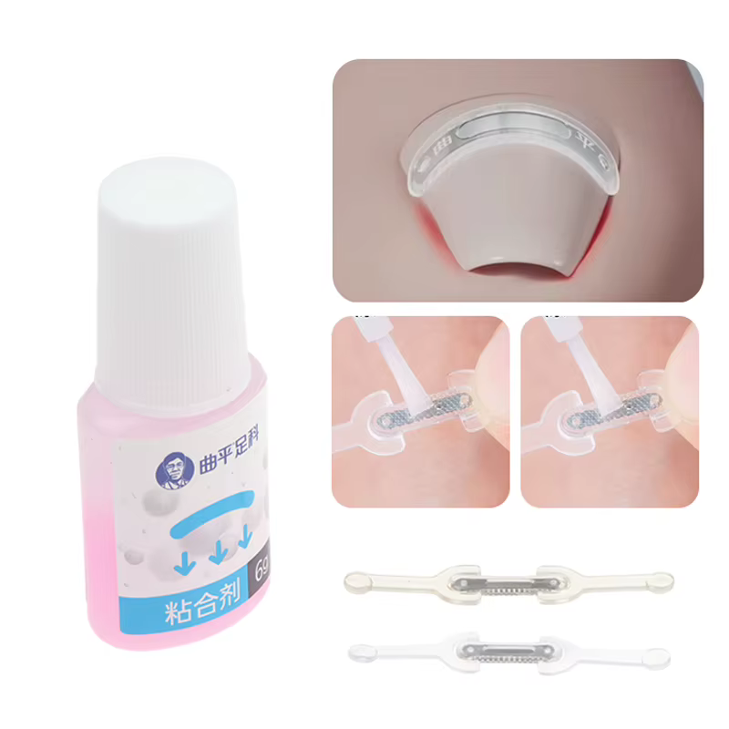 Soins des ongles, Correction des ongles incarnés