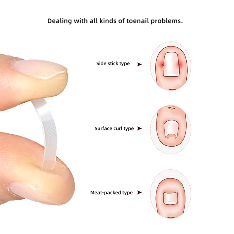 Traitement des ongles incarnés