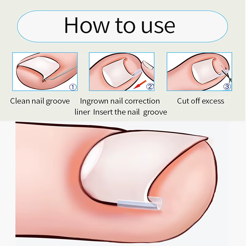 Outil de Correction des ongles incarnés