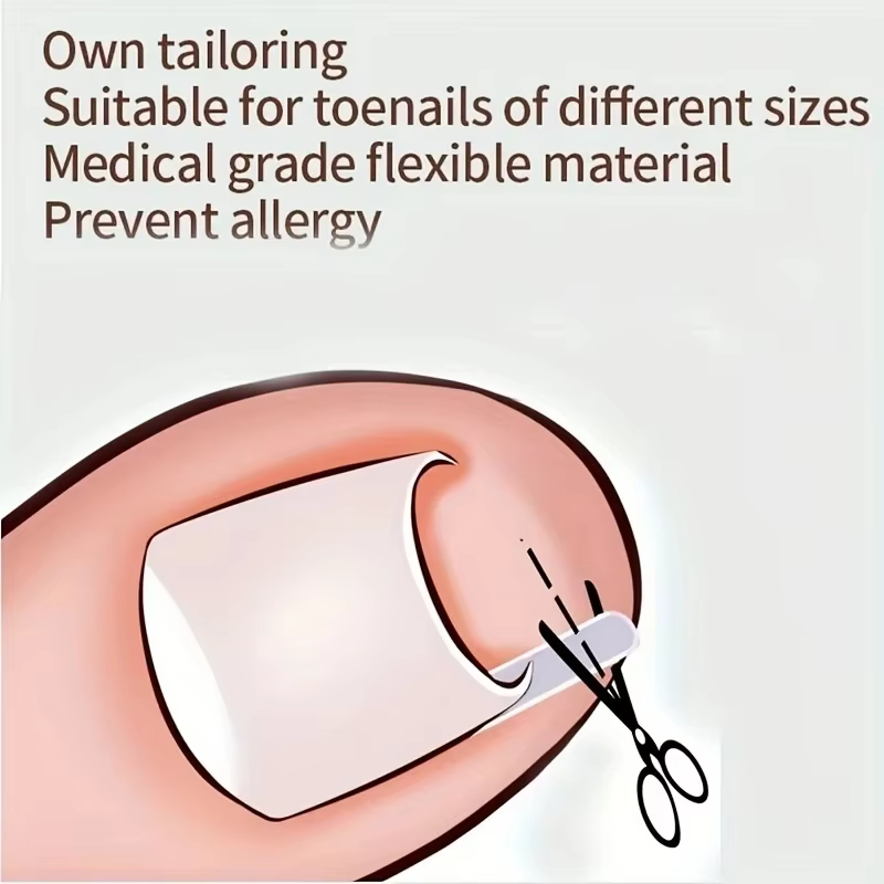 Outil de Correction des ongles incarnés