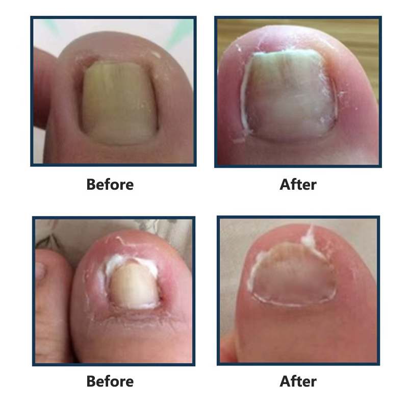 Outil de traitement des ongles incarnés