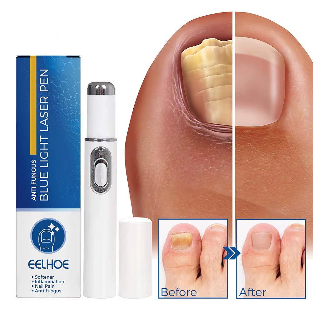 Stylo Laser pour traitement des champignons des ongles