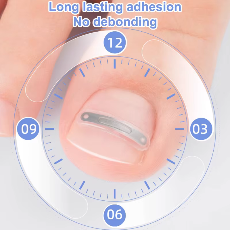 Soins des ongles, Correction des ongles incarnés