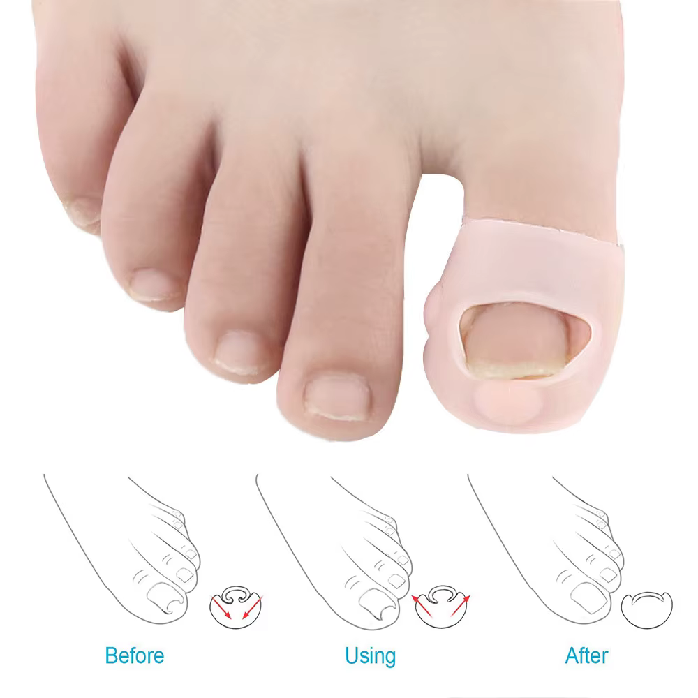 Pexmen 2/4/10 pièces Gel correcteur d'ongle incarné manches gros orteil ongles guérison soins protecteurs Paronychia traitement pédicure outil