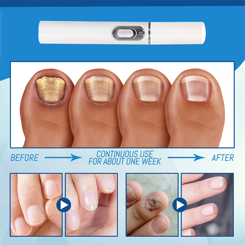 Stylo Laser pour traitement des champignons des ongles