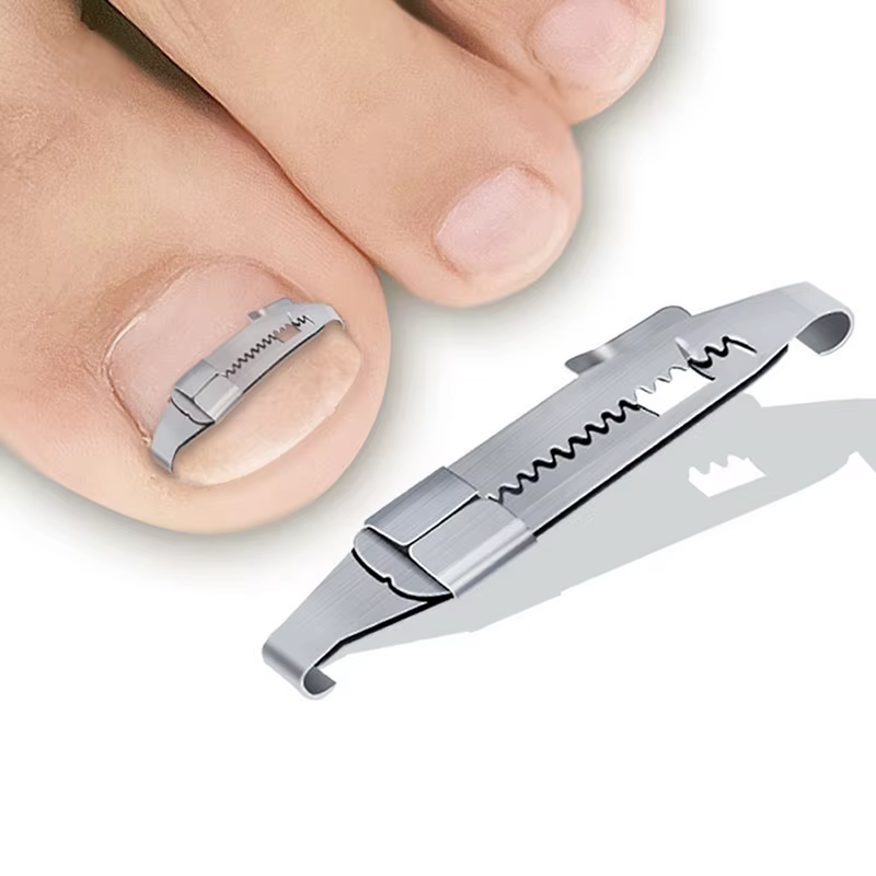 Correcteur d'ongles incarnés