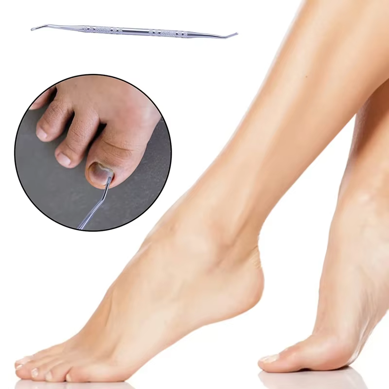Ensemble de Correction des ongles incarnés