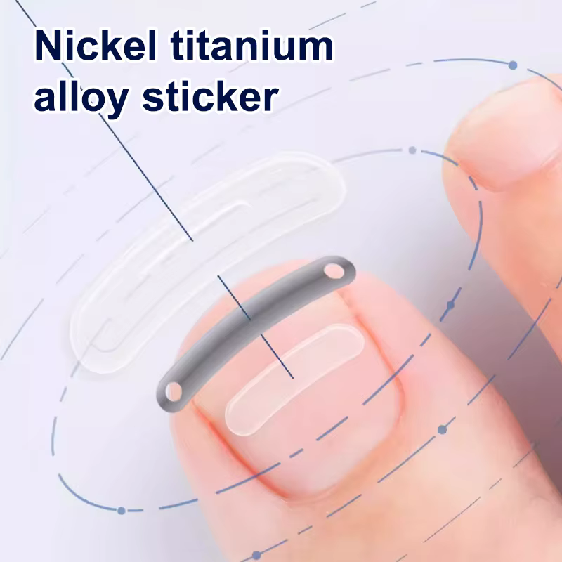 Soins des ongles, Correction des ongles incarnés