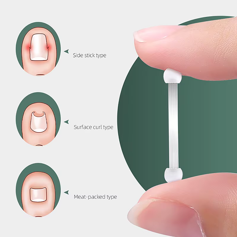 Correcteur d'ongles incarnés