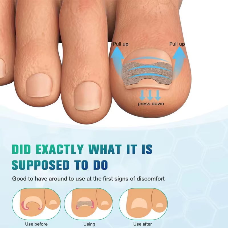 Autocollants de Correction des ongles incarnés