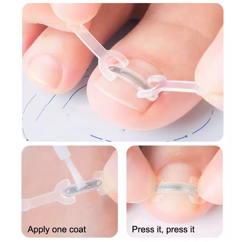 Soins des ongles, Correction des ongles incarnés