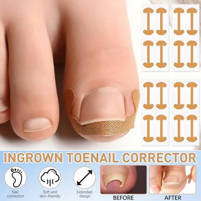 Ensemble de Correction des ongles incarnés